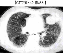 肺がんのCT検査
