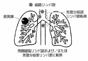 肺がんリンパ節転移