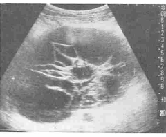 卵巣がんの超音波検査