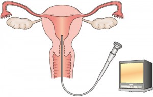 子宮体がんの精密検査