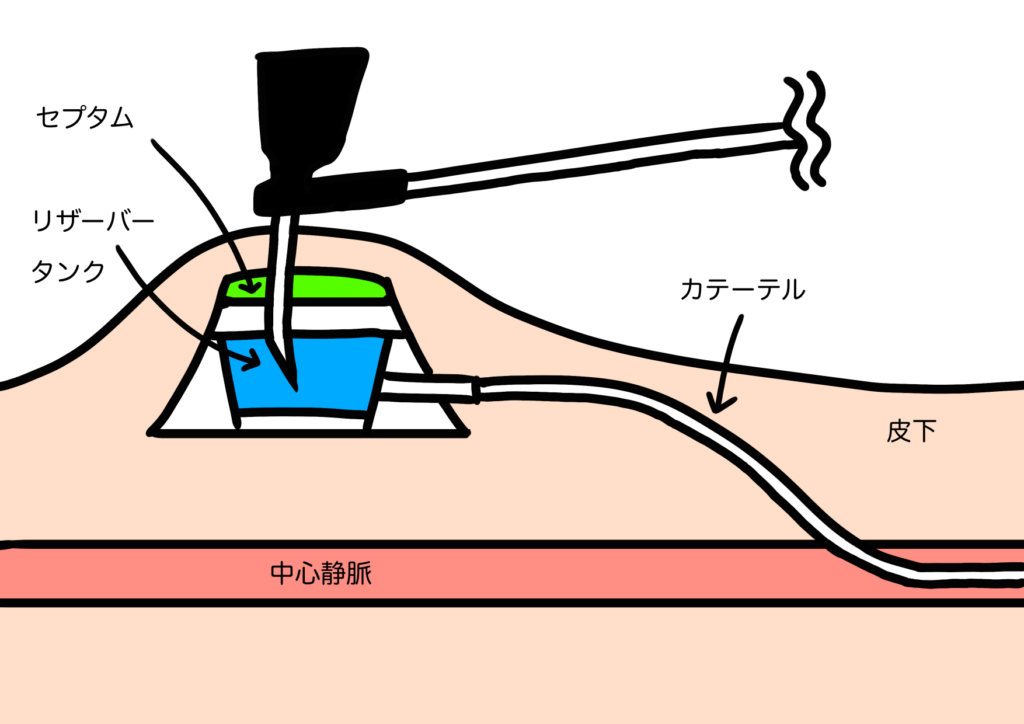 がんCVポート